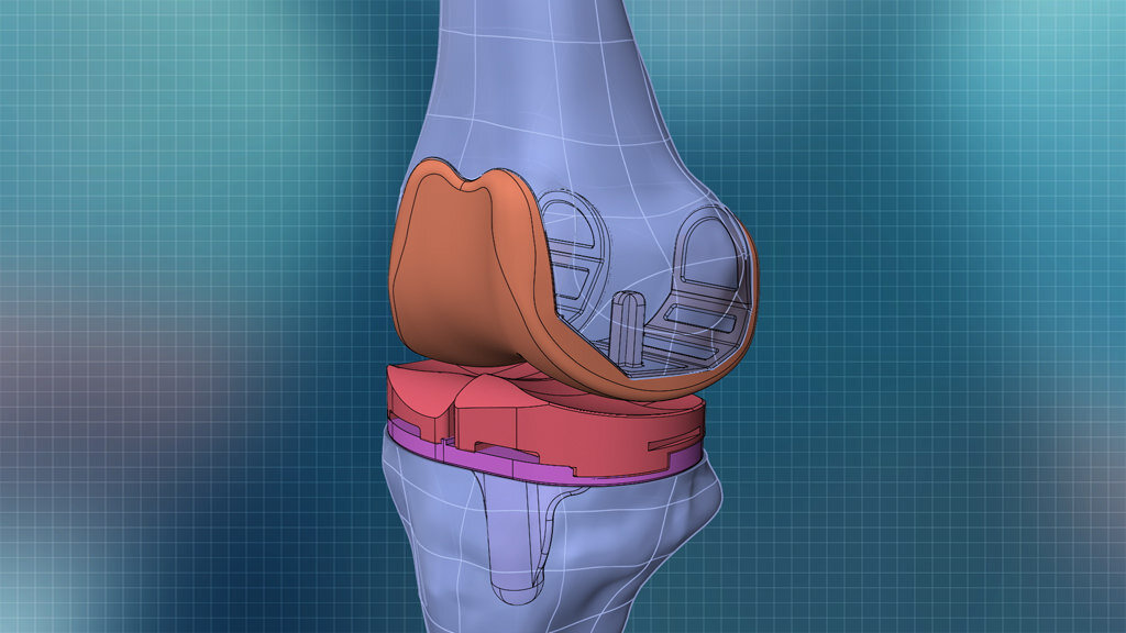 Conformis - Form, Fit, Function | Dr Jonathan Cabot | Orthopaedic Surgeon | Adelaide